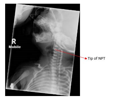 NPT for PRS xray